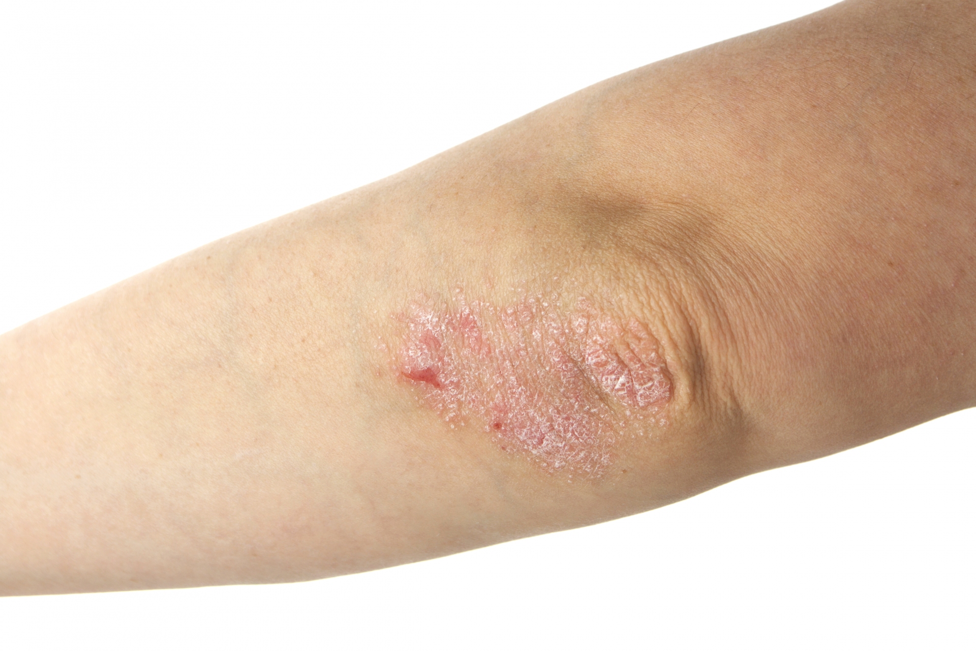 Psoriasis on the elbow