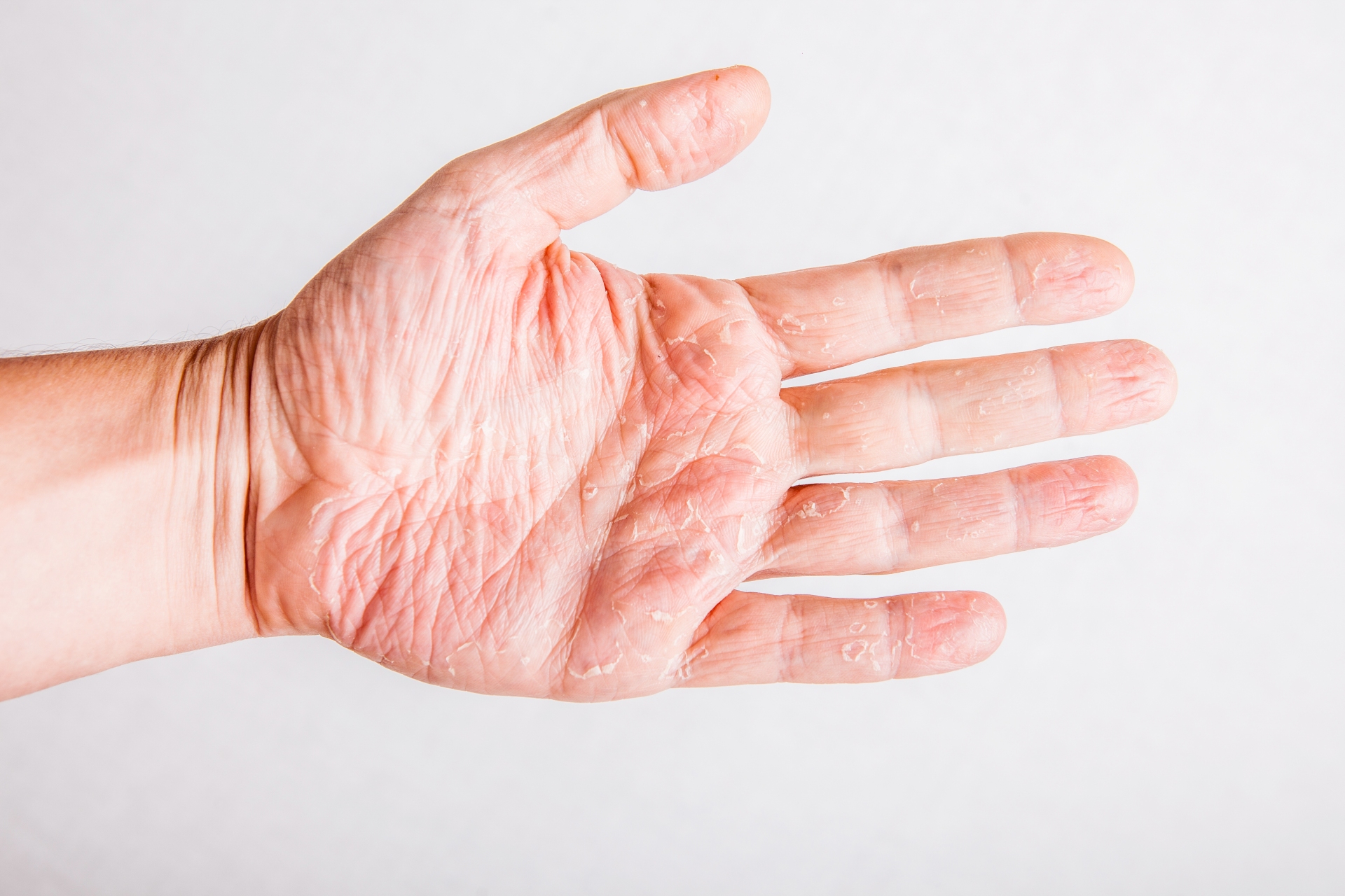 Hand eczema