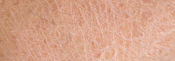 Kuiv nahk (ichthyosis)